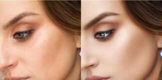 Pigmentation Treatment Singapore: Your Treatment Options, How to Prepare and What to Expect during Treatment