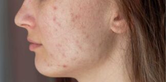 Pigmentation Removal Singapore: What does a bad Pigmentation look Like?