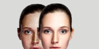 Melasma Treatment Singapore: What is the Gold Standard?